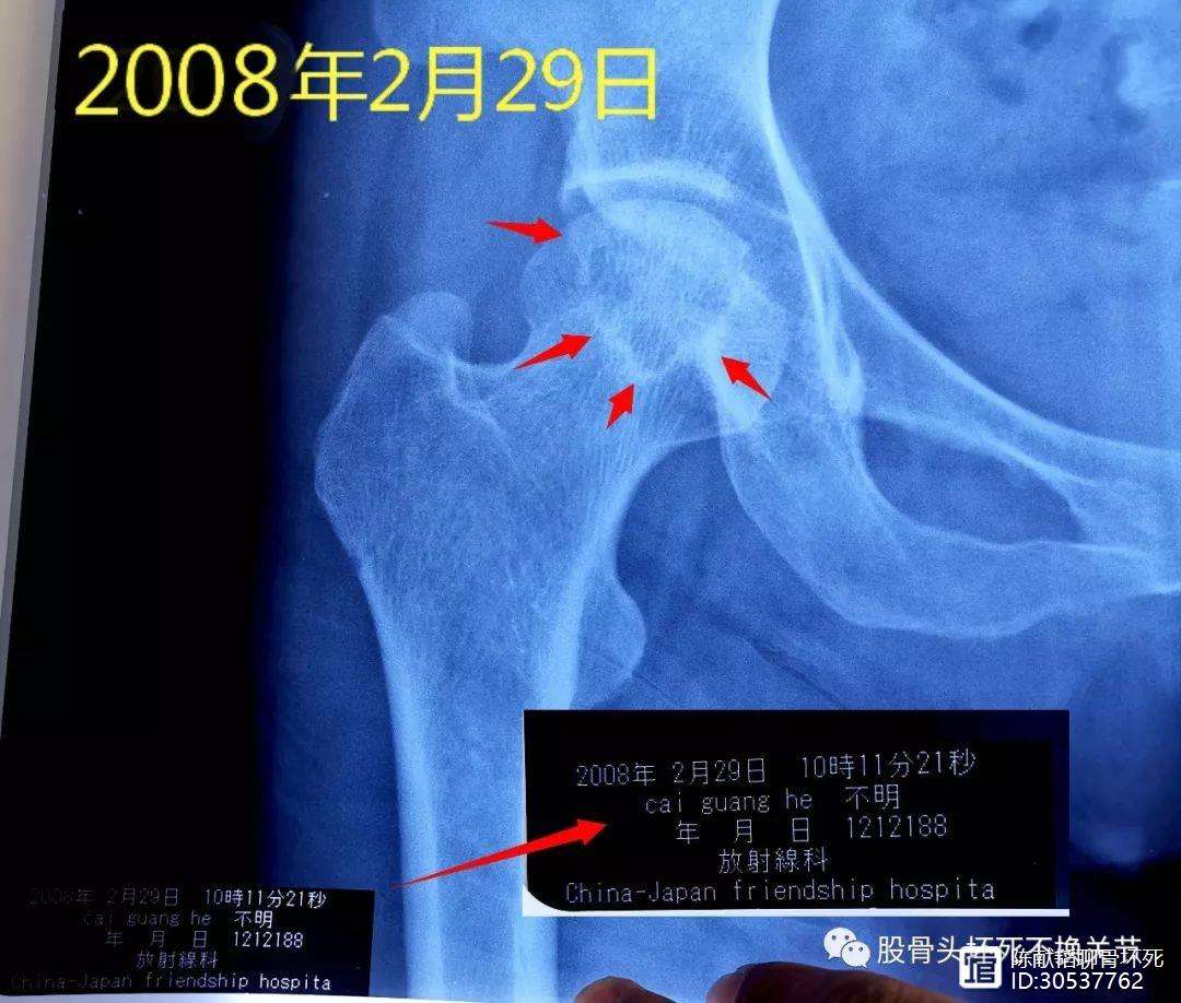 赤峰人工骨头医保报销多少(人工骨头医保报销多少比例)